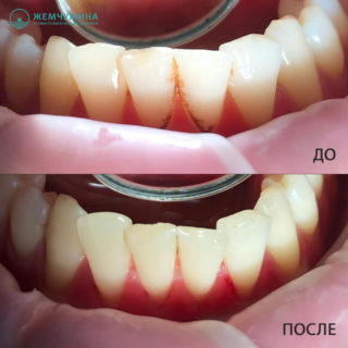 Профгигиена зубов https://pearlkzn.ru/wp-content/uploads/2022/01/8-320x320.jpg