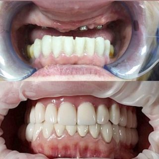Имплантация зубов https://pearlkzn.ru/wp-content/uploads/2022/01/photo-20211129_221336-320x320.jpg