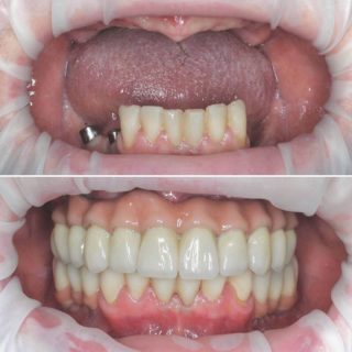 Имплантация зубов https://pearlkzn.ru/wp-content/uploads/2022/01/photo-20211129_230717-320x320.jpg